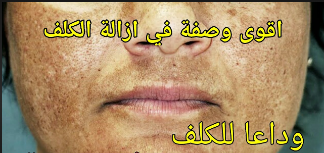تخلصي من الكلف والنمش بوصفة منزلية سريعة المفعول