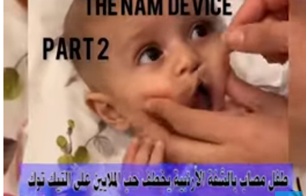 طفل ولد بدون شفة