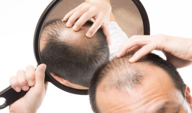 علاج فقدان الشعر