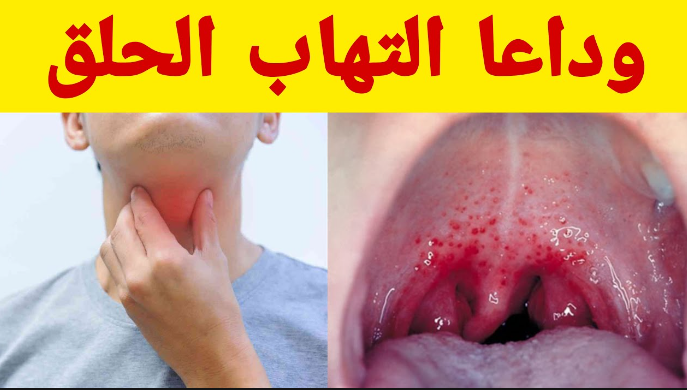 علاج التهاب الحلق 