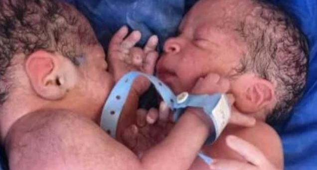 ولادة توأم ملتصق نادر بمستشفى الزقازيق الجامعي